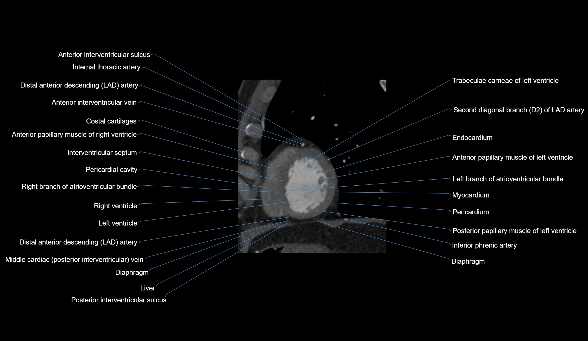 CT heart (coronary angiogram) short axis view  cross sectional anatomy labelled radiology image-00041.webp